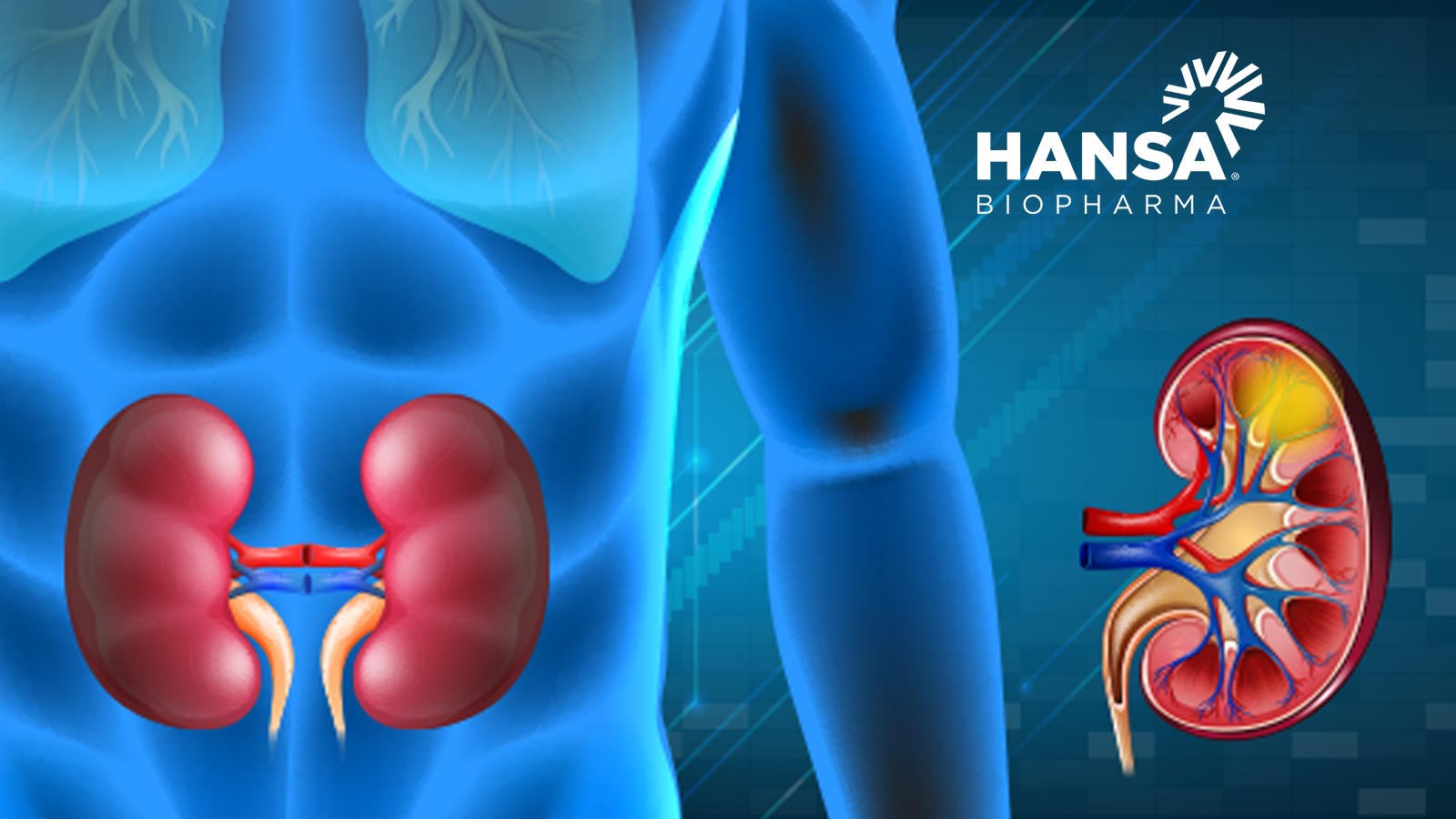 Hansa Biopharma Enrolls First Patient In U.S. Randomized, Controlled Pivotal Trial Of Imlifidase In Highly Sensitized Kidney Transplant Patients